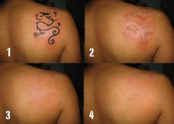 Laserbehandeling voor tattoo verwijdering